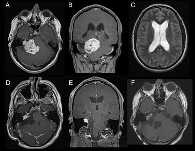 Microsurgical Treatment and Follow-Up of KOOS Grade IV Vestibular Schwannoma: Therapeutic Concept and Future Perspective